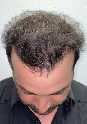 hair transplant photos