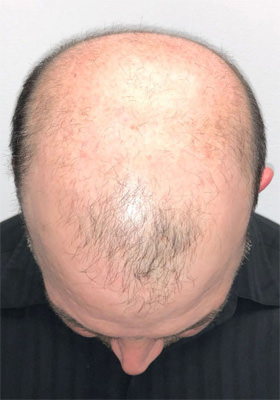 hair transplant photos