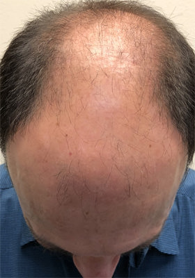 hair transplant before after Photos