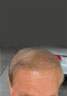 hair transplant photos