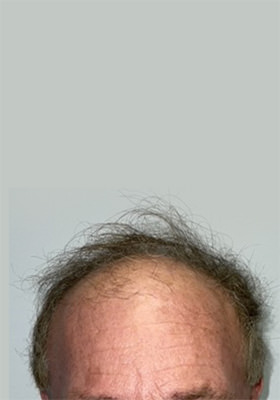 hair transplant before after Photos