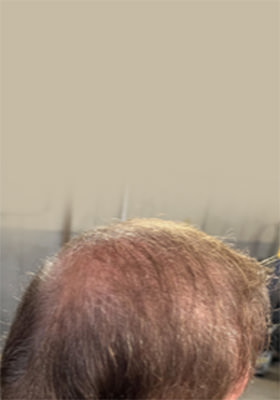 hair transplant photos