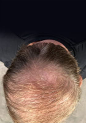 hair transplant photos