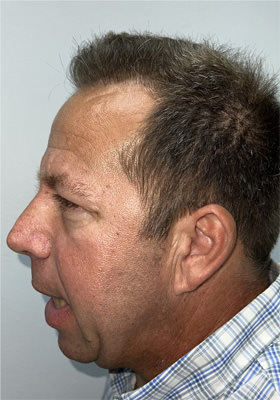 hair transplant photos