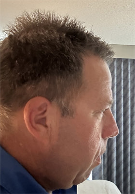 hair transplant photos