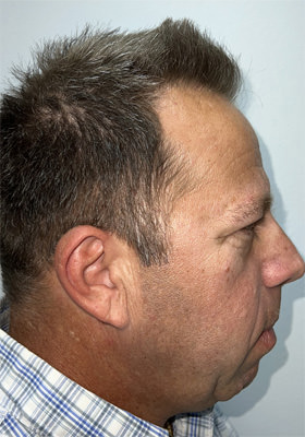 hair transplant photos