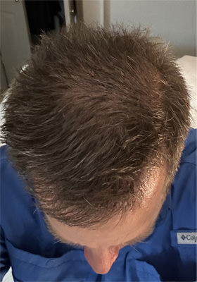 hair transplant before after Photos