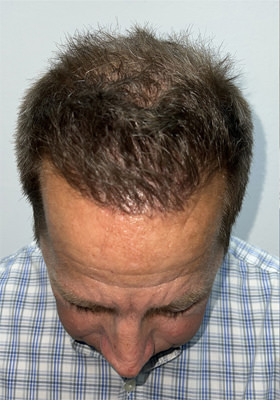 hair transplant photos