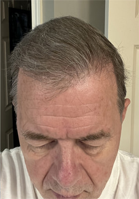 hair transplant photos