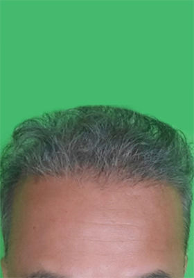 hair transplant before after Photos