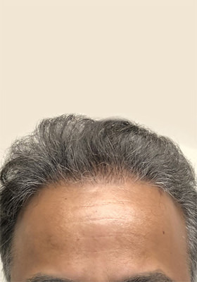 hair transplant photos