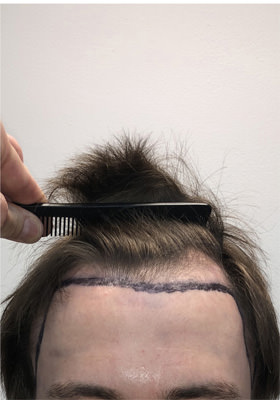 hair transplant before after Photos