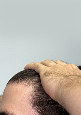 hair transplant photos