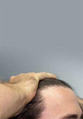 hair transplant photos