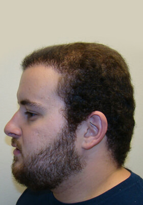 hair transplant photos