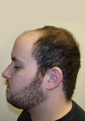 hair transplant photos