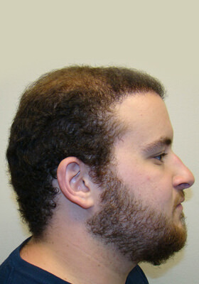 hair transplant photos