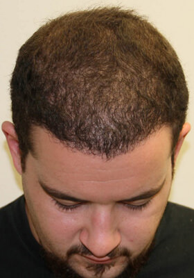 hair transplant before after Photos