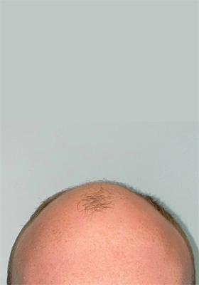 hair transplant photos