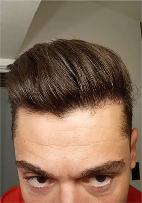 hair transplant before after Photos