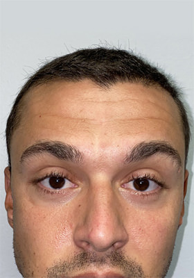 hair transplant photos