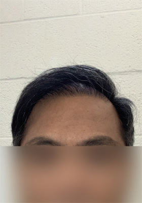 hair transplant photos