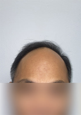 hair transplant photos