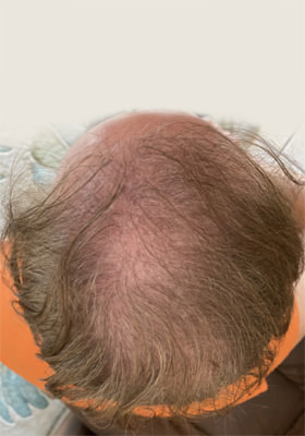 hair transplant photos