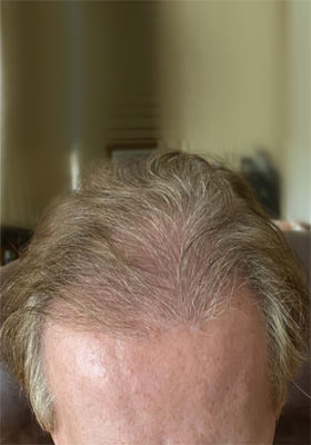 hair transplant photos