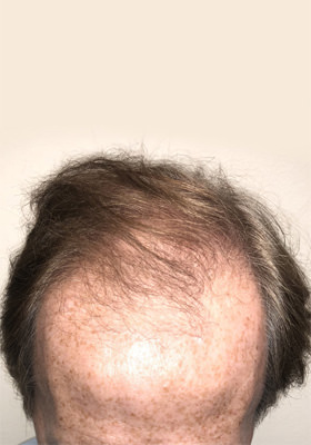 hair transplant photos