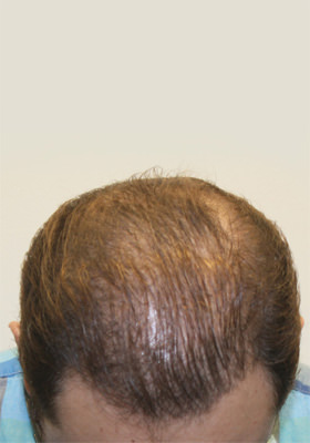 hair transplant photos