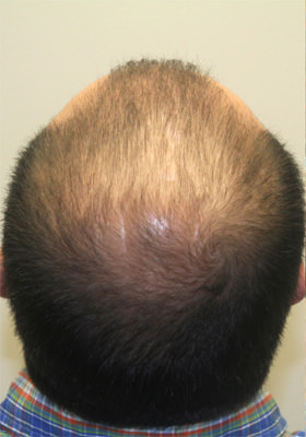 hair transplant photos