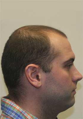 hair transplant photos