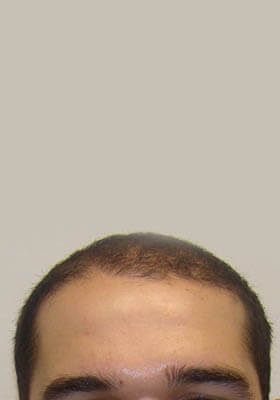 hair transplant photos