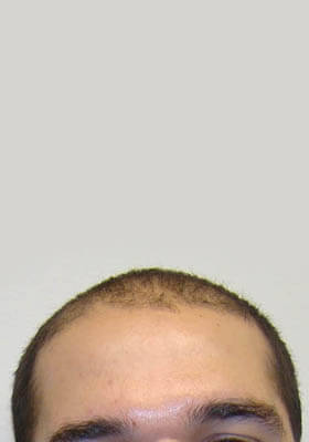 hair transplant photos