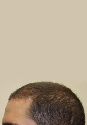 hair transplant photos