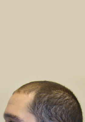 hair transplant photos
