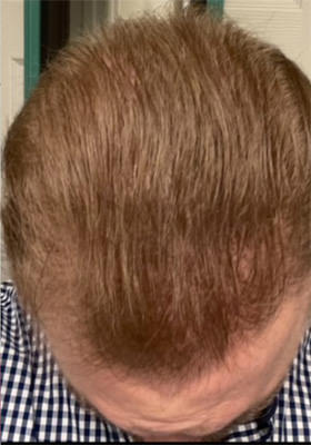 hair transplant before after Photos