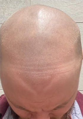 hair transplant before after Photos