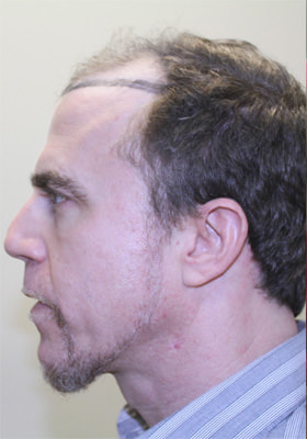 hair transplant photos