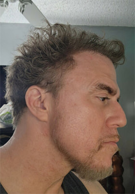 hair transplant photos