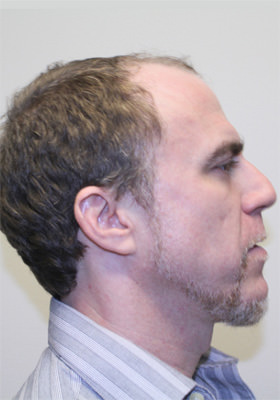 hair transplant photos