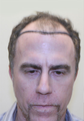 hair transplant photos