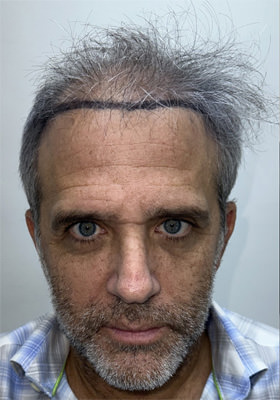 hair transplant before after Photos