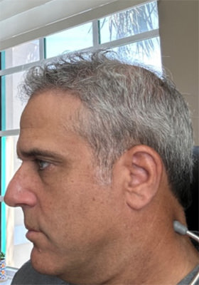 hair transplant photos