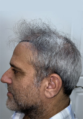 hair transplant photos