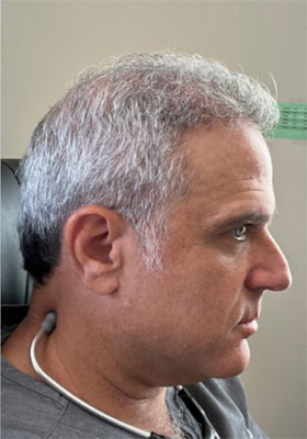 hair transplant photos