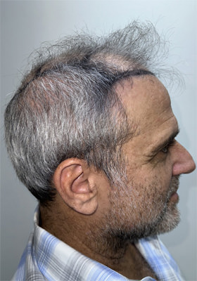 hair transplant photos