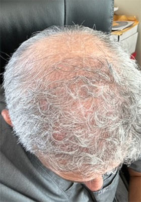 hair transplant photos