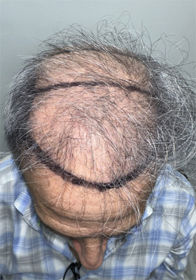 hair transplant photos